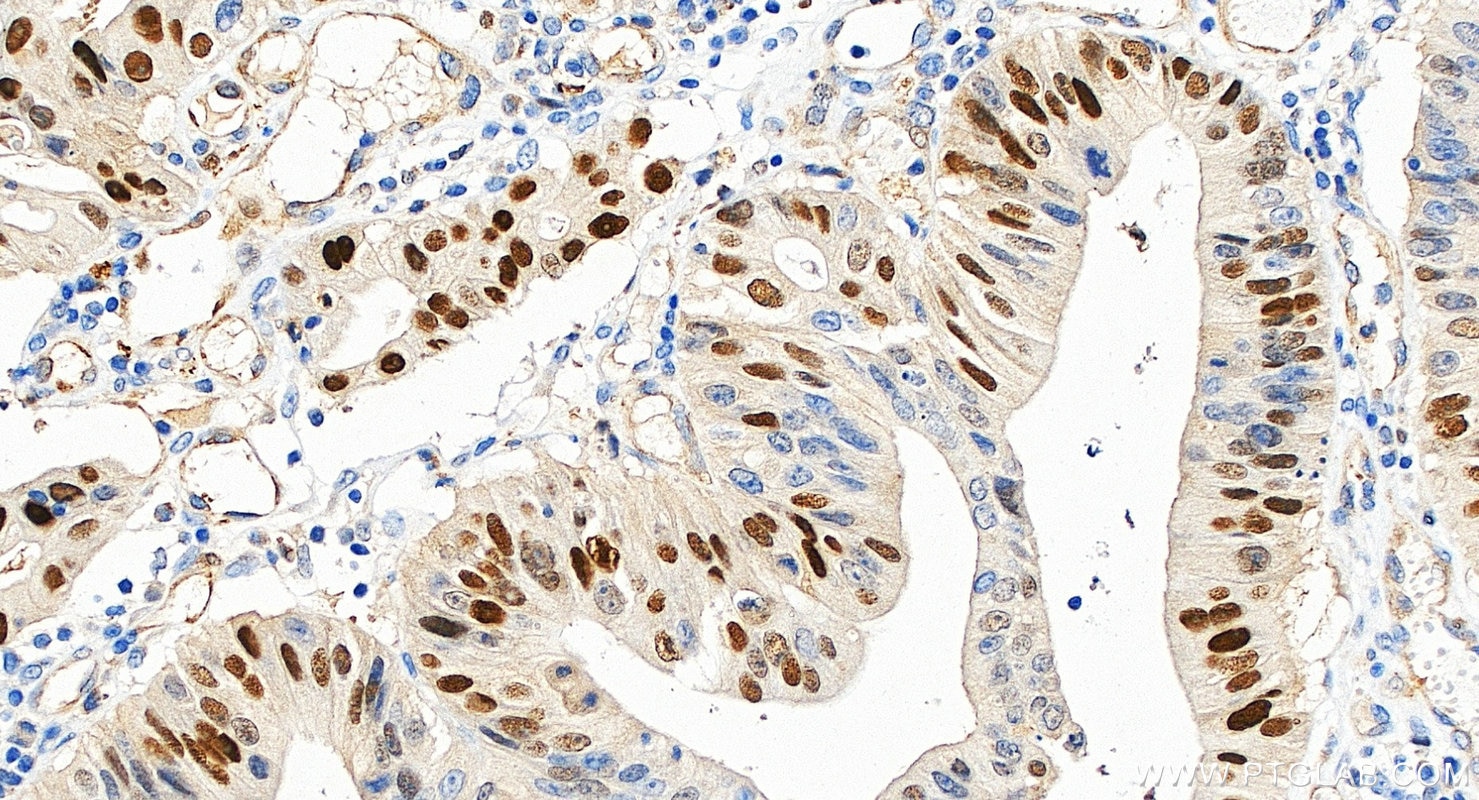 Immunohistochemistry (IHC) staining of human colon cancer tissue using P21 Polyclonal antibody (10355-1-AP)