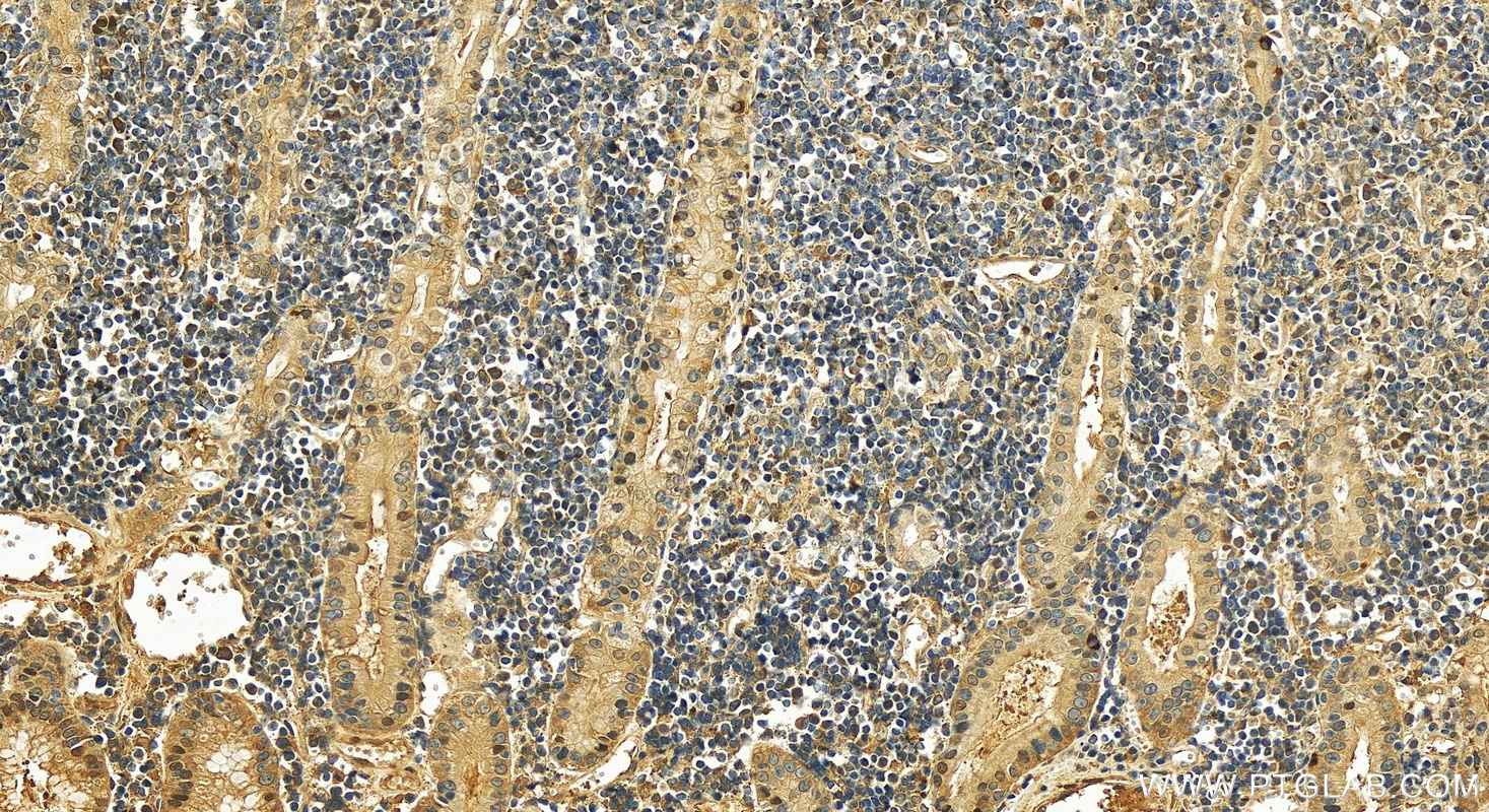 Immunohistochemistry (IHC) staining of human stomach cancer tissue using P21 Polyclonal antibody (10355-1-AP)