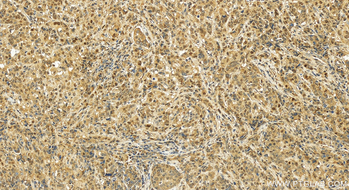 Immunohistochemistry (IHC) staining of human stomach cancer tissue using P21 Polyclonal antibody (10355-1-AP)