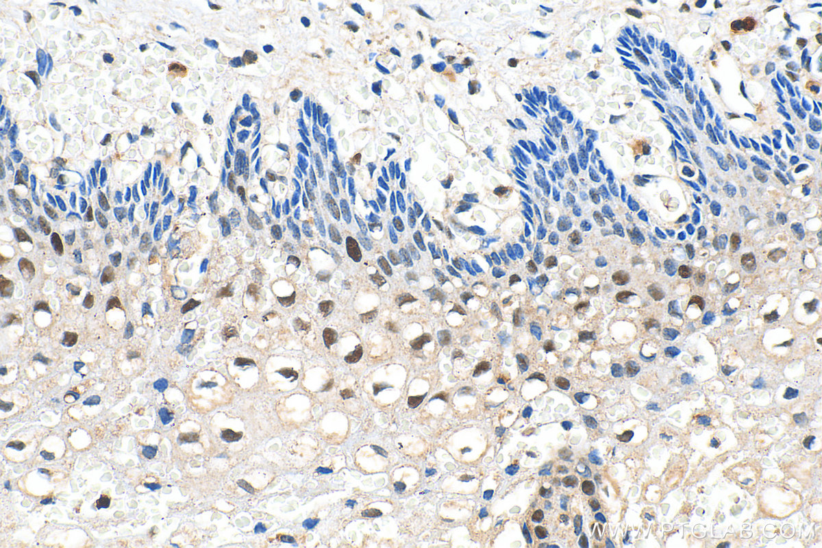 Immunohistochemistry (IHC) staining of human cervical cancer tissue using P21 Polyclonal antibody (10355-1-AP)