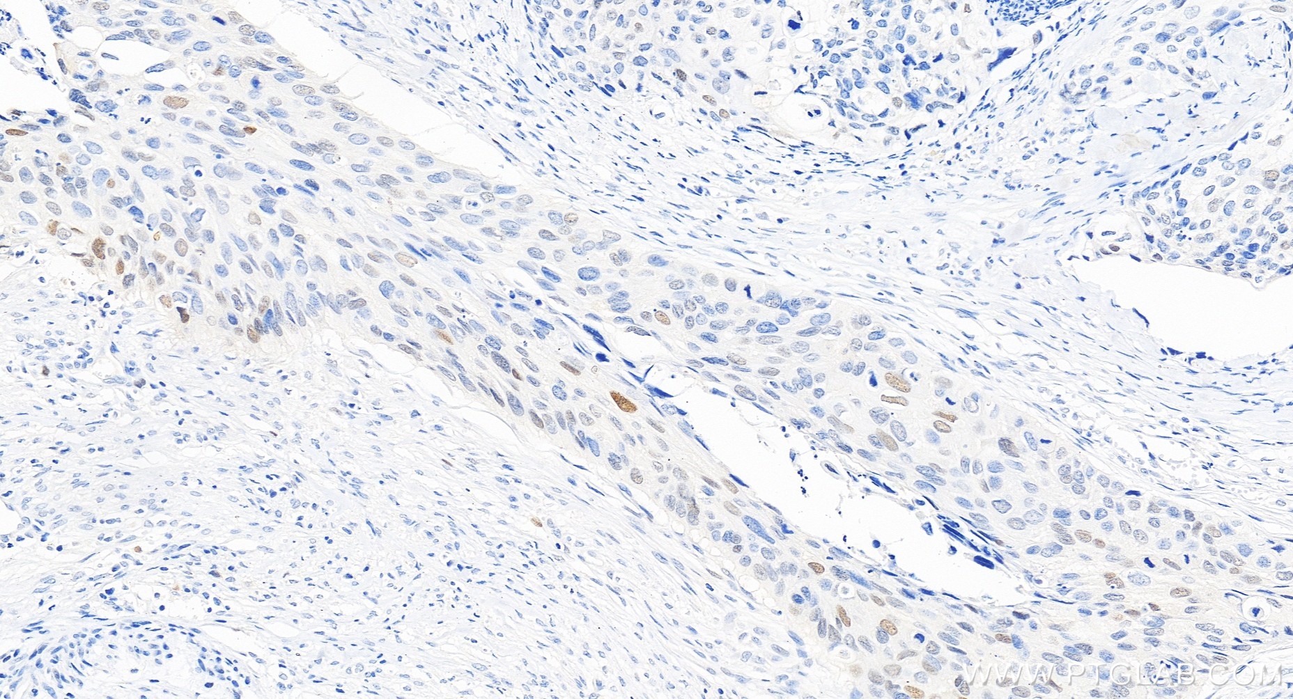 Immunohistochemistry (IHC) staining of human cervical cancer tissue using P21 Recombinant monoclonal antibody (82669-2-RR)