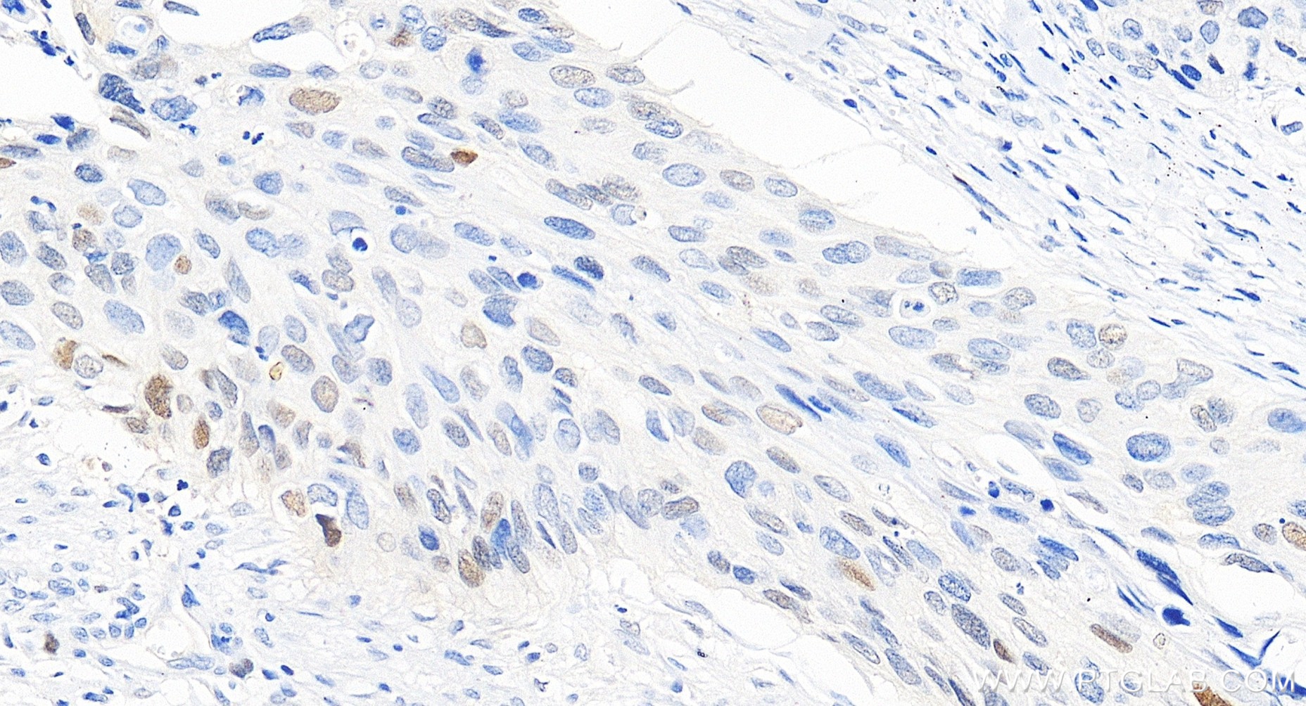 Immunohistochemistry (IHC) staining of human cervical cancer tissue using P21 Recombinant monoclonal antibody (82669-2-RR)