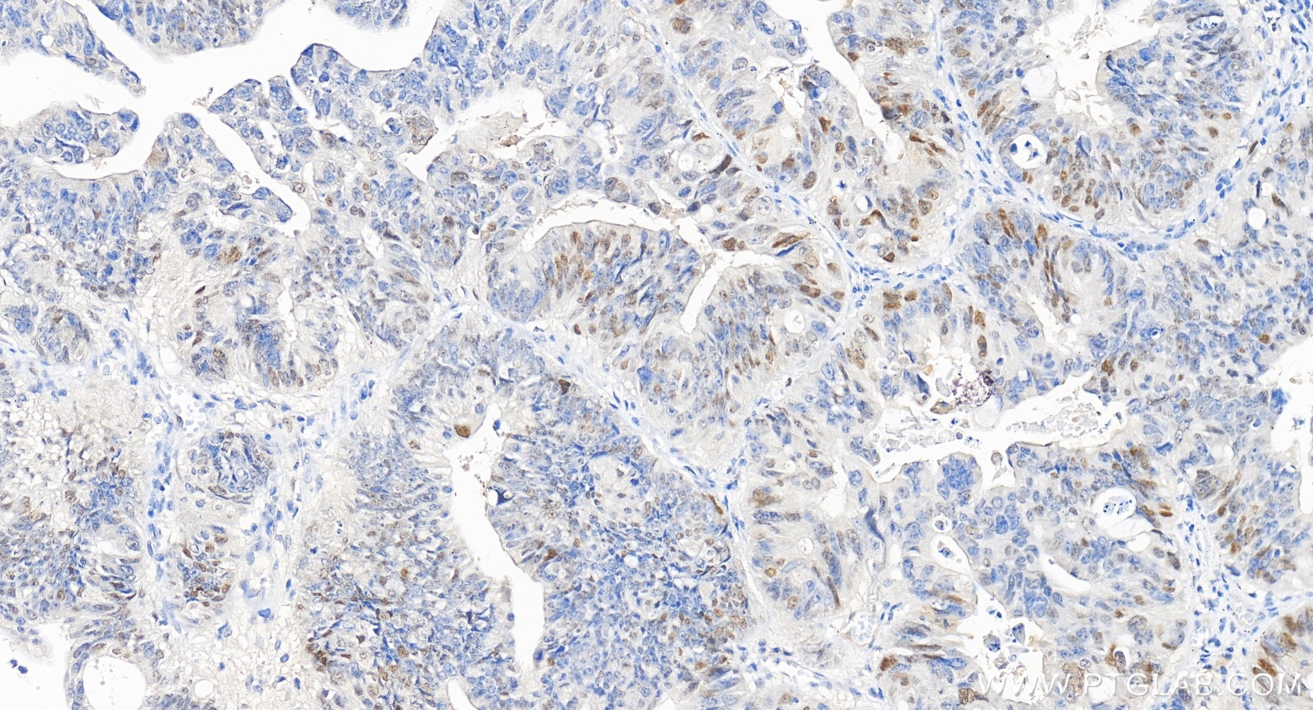 Immunohistochemistry (IHC) staining of human colon cancer tissue using P21 Recombinant monoclonal antibody (82669-2-RR)