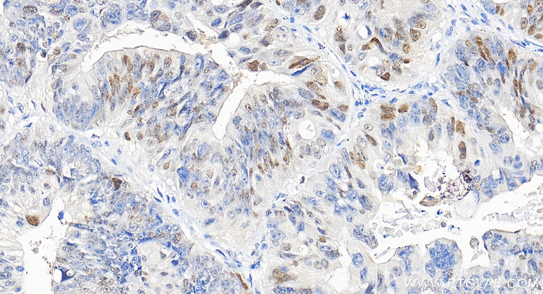 Immunohistochemistry (IHC) staining of human colon cancer tissue using P21 Recombinant monoclonal antibody (82669-2-RR)