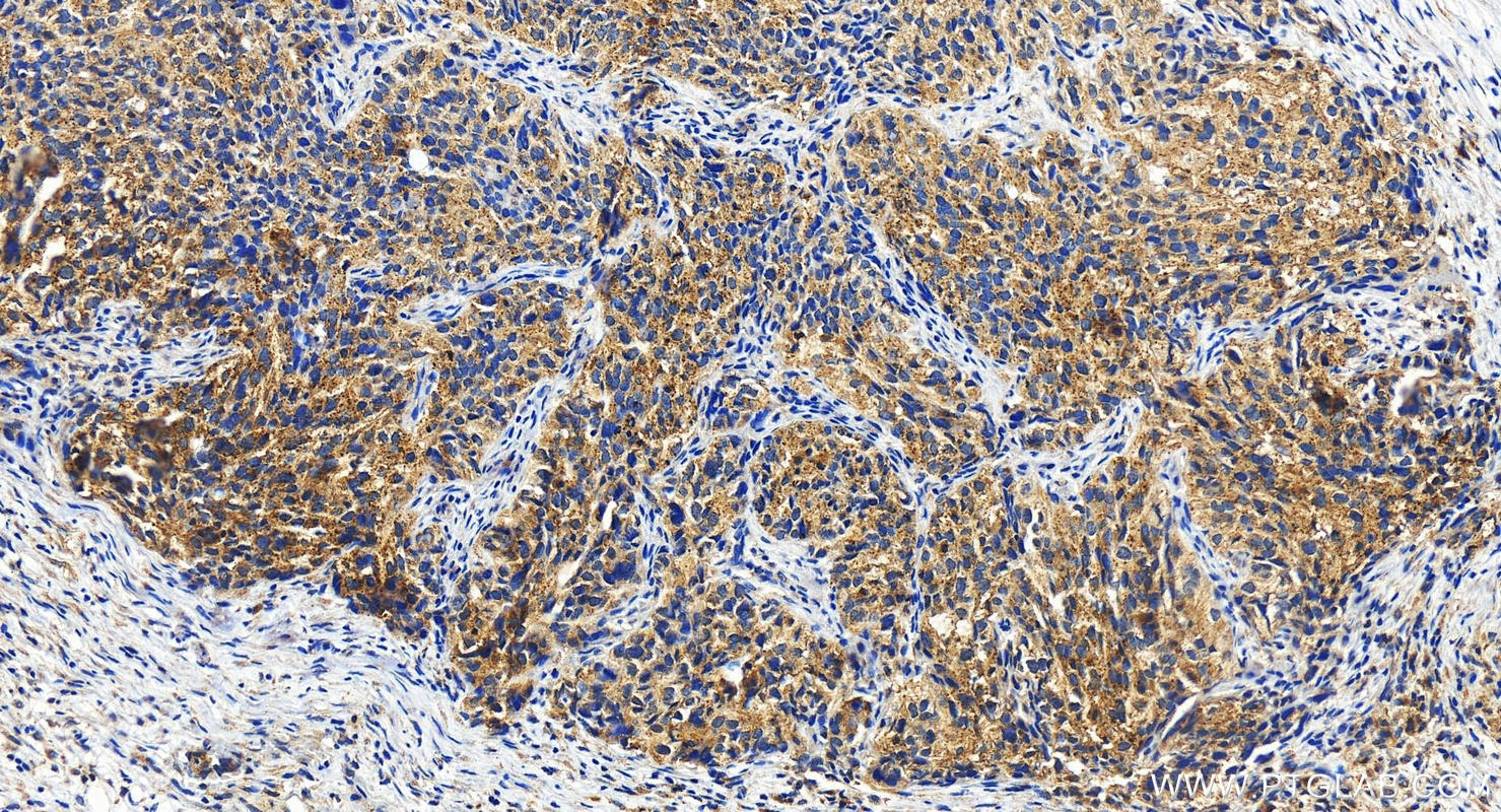 Immunohistochemistry (IHC) staining of human ovary cancer tissue using P2RX4 Polyclonal antibody (13534-1-AP)