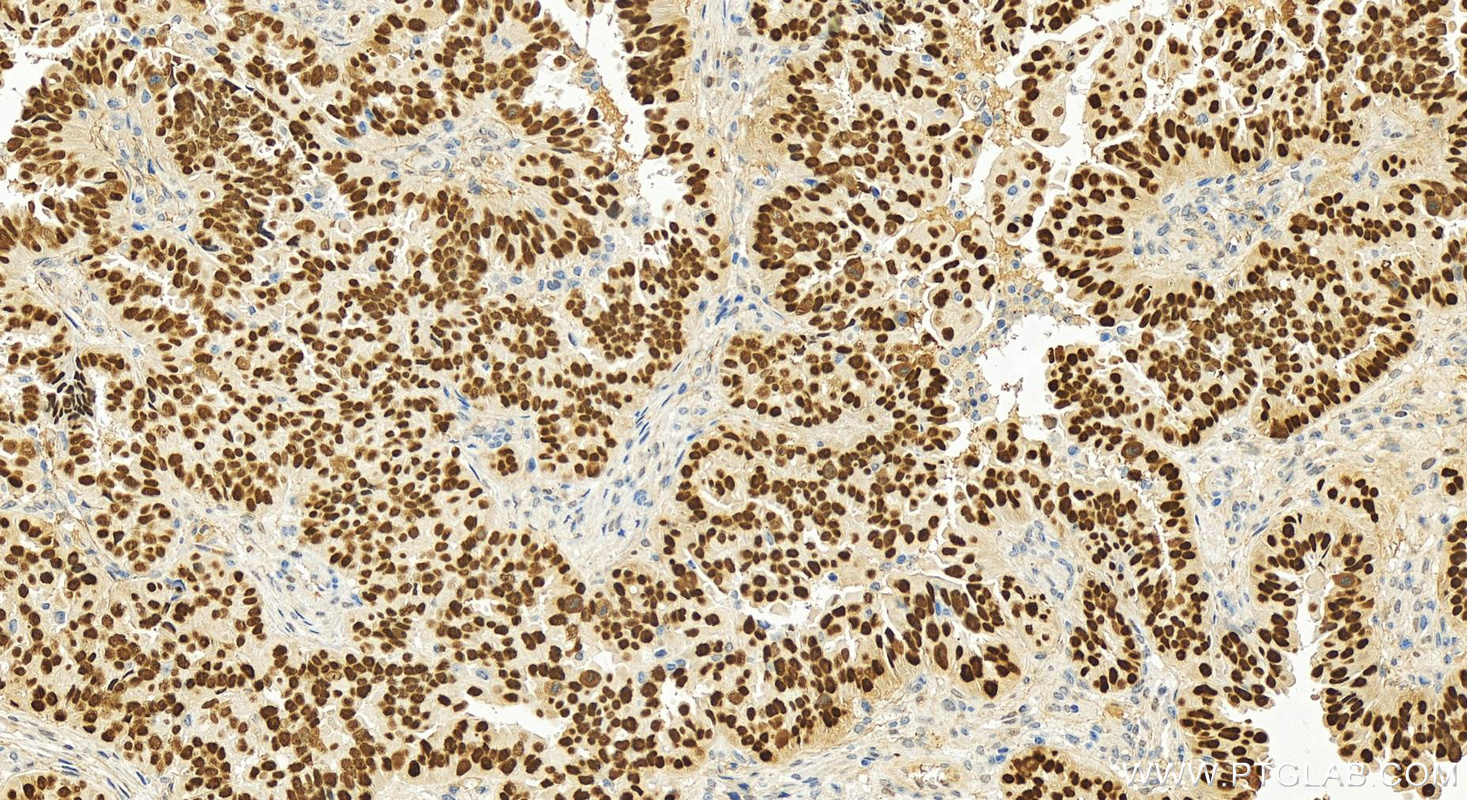 Immunohistochemistry (IHC) staining of human ovary cancer tissue using P53 Polyclonal antibody (10442-1-AP)