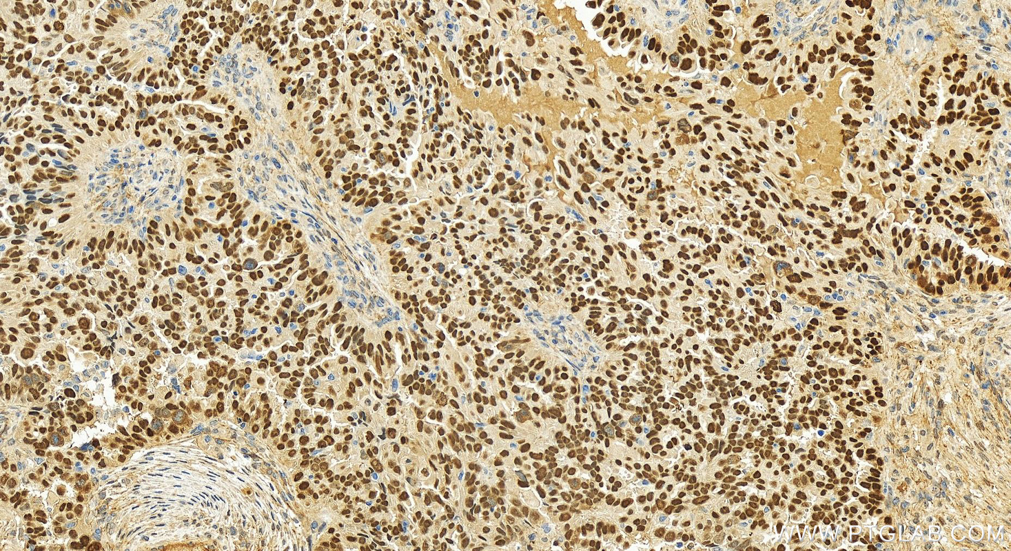 Immunohistochemistry (IHC) staining of human ovary cancer tissue using P53 Polyclonal antibody (10442-1-AP)