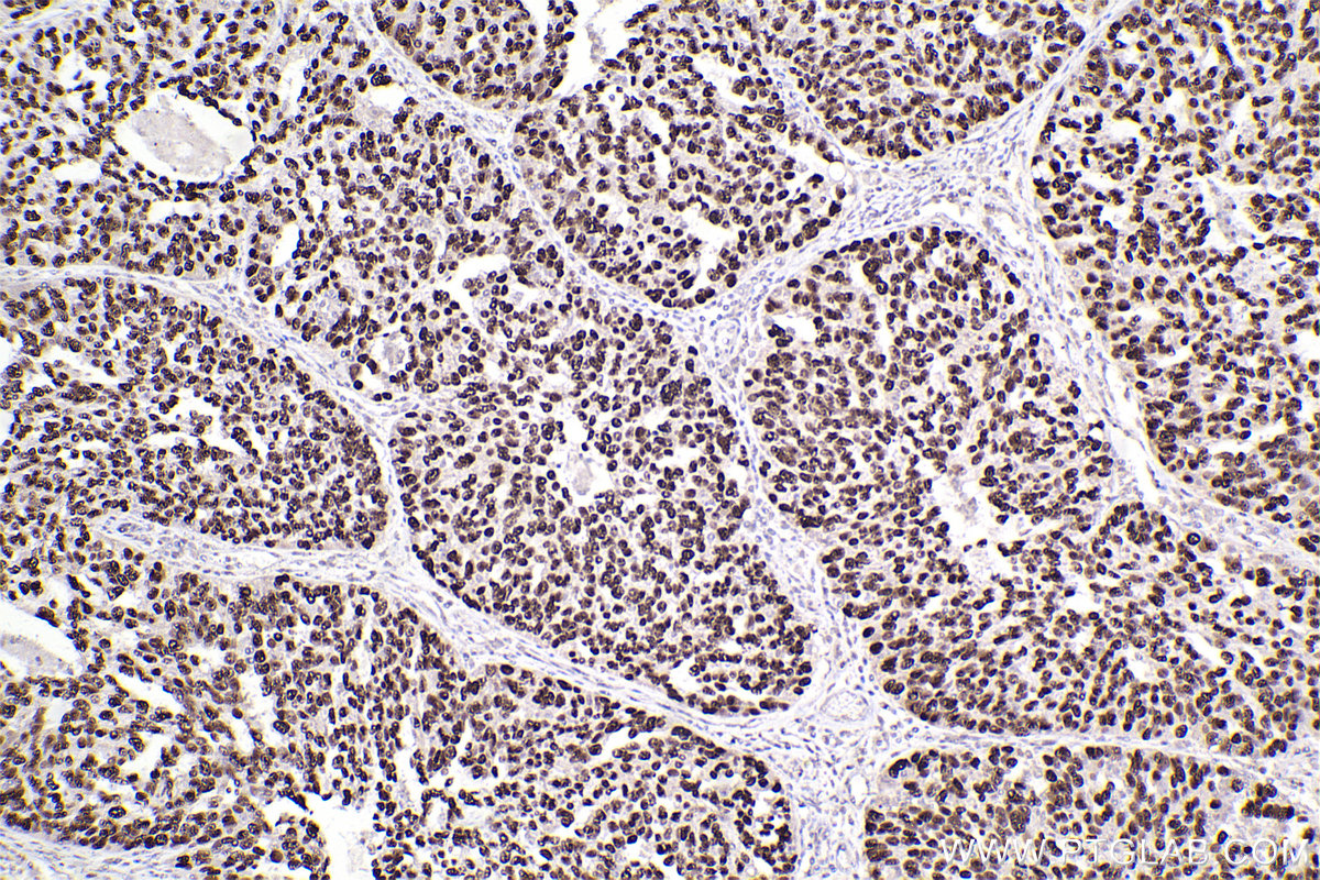 Immunohistochemistry (IHC) staining of human ovary cancer tissue using P53 Monoclonal antibody (60283-2-Ig)