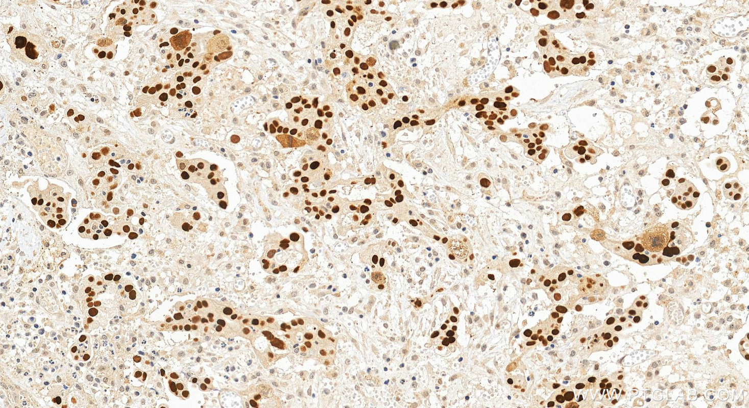 Immunohistochemistry (IHC) staining of human ovary cancer tissue using P53 Monoclonal antibody (60283-2-Ig)