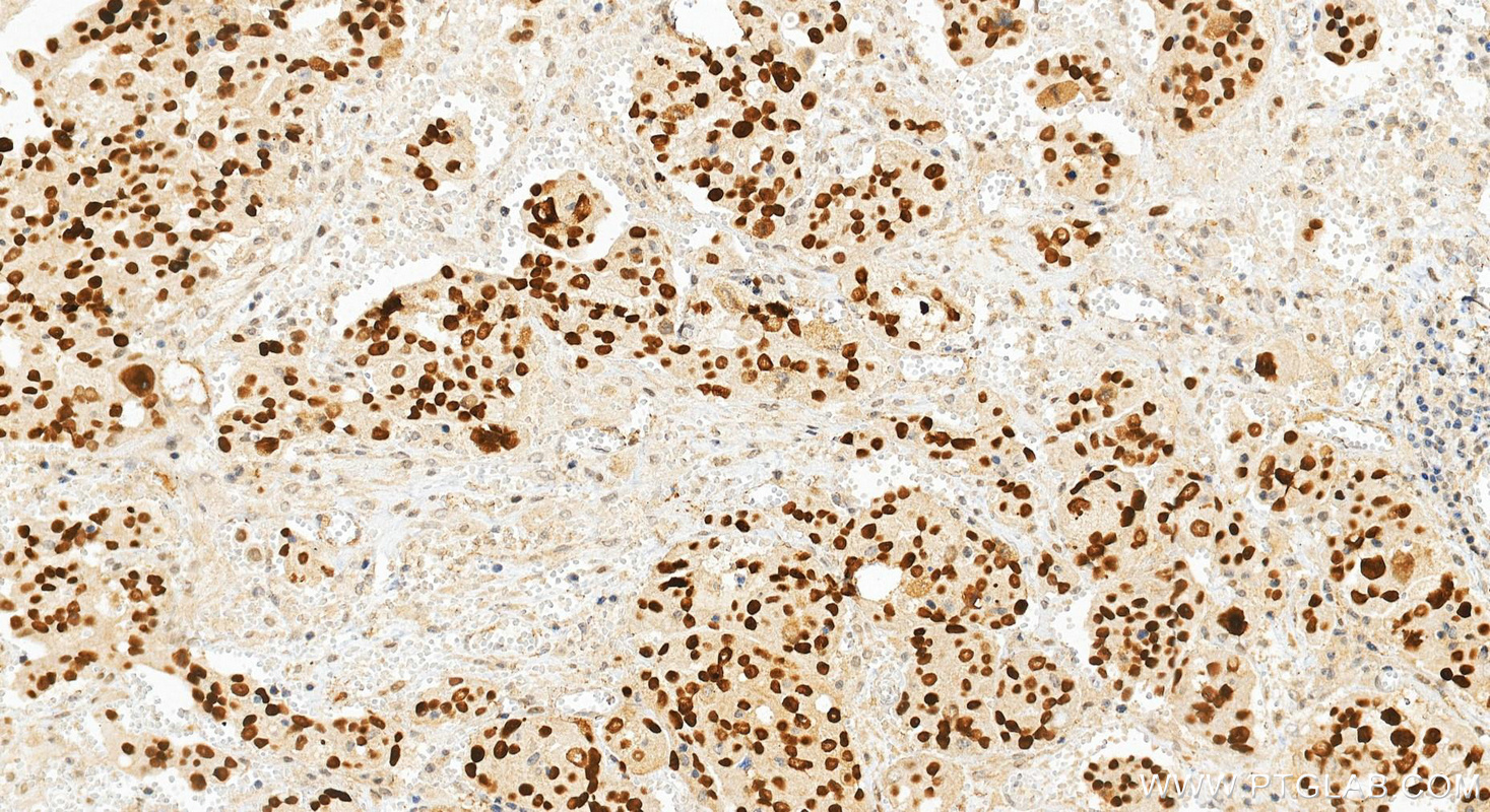 Immunohistochemistry (IHC) staining of human ovary cancer tissue using P53 Monoclonal antibody (60283-2-Ig)