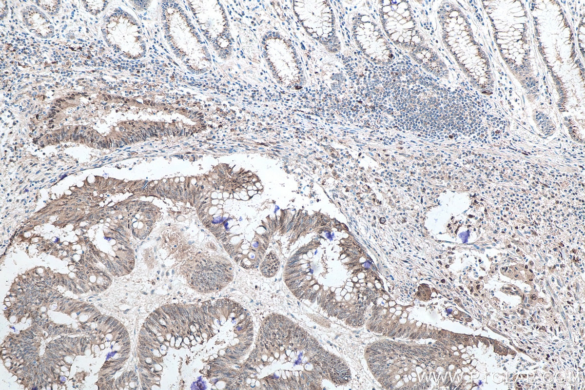 Immunohistochemistry (IHC) staining of human colon cancer tissue using P62/SQSTM1 Monoclonal antibody (66184-1-Ig)