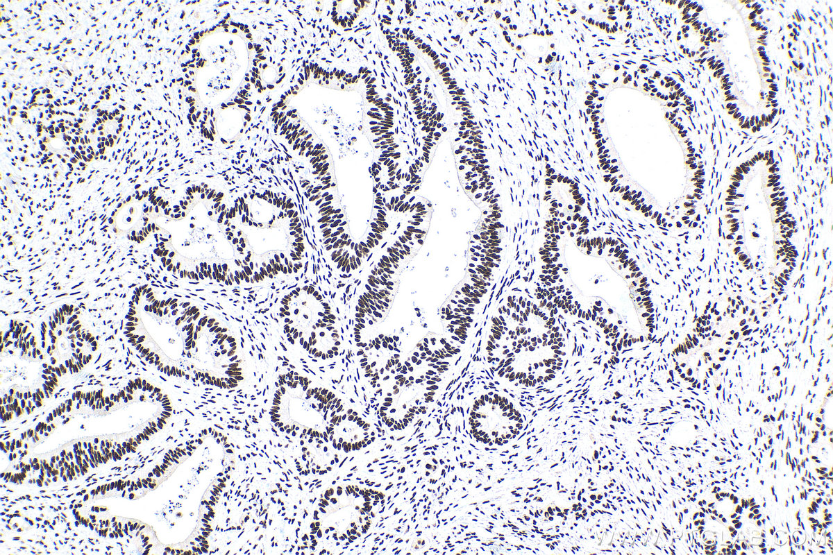 Immunohistochemistry (IHC) staining of human colon cancer tissue using PABPN1 Monoclonal antibody (66807-1-Ig)