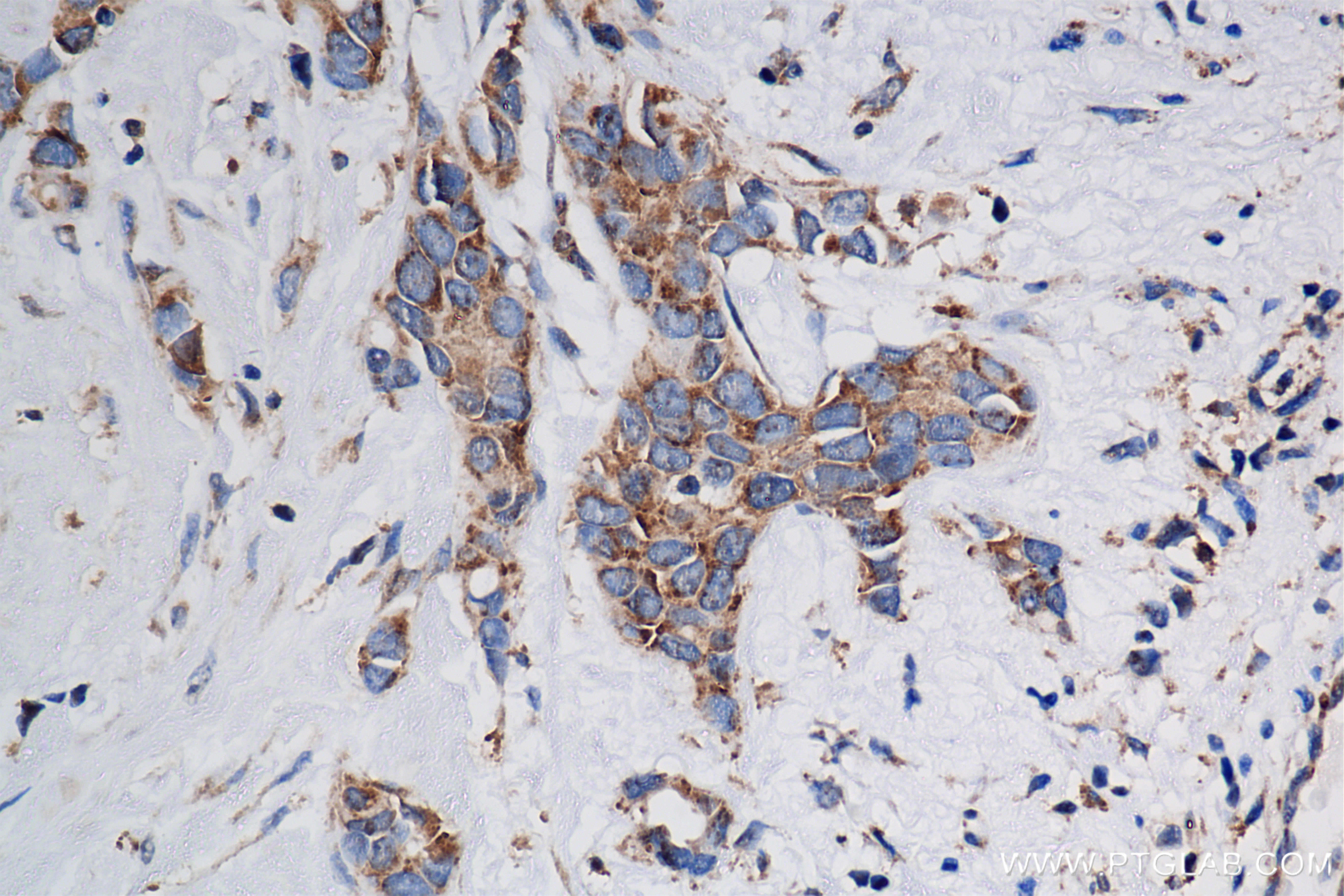 Immunohistochemistry (IHC) staining of human breast cancer tissue using PACSIN2 Recombinant antibody (84763-4-RR)