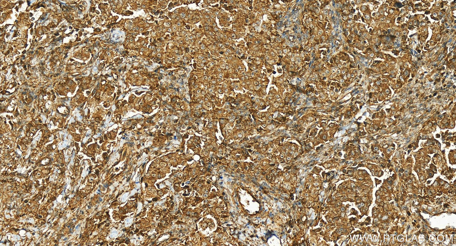 Immunohistochemistry (IHC) staining of human ovary cancer tissue using PAG1 Polyclonal antibody (25029-1-AP)