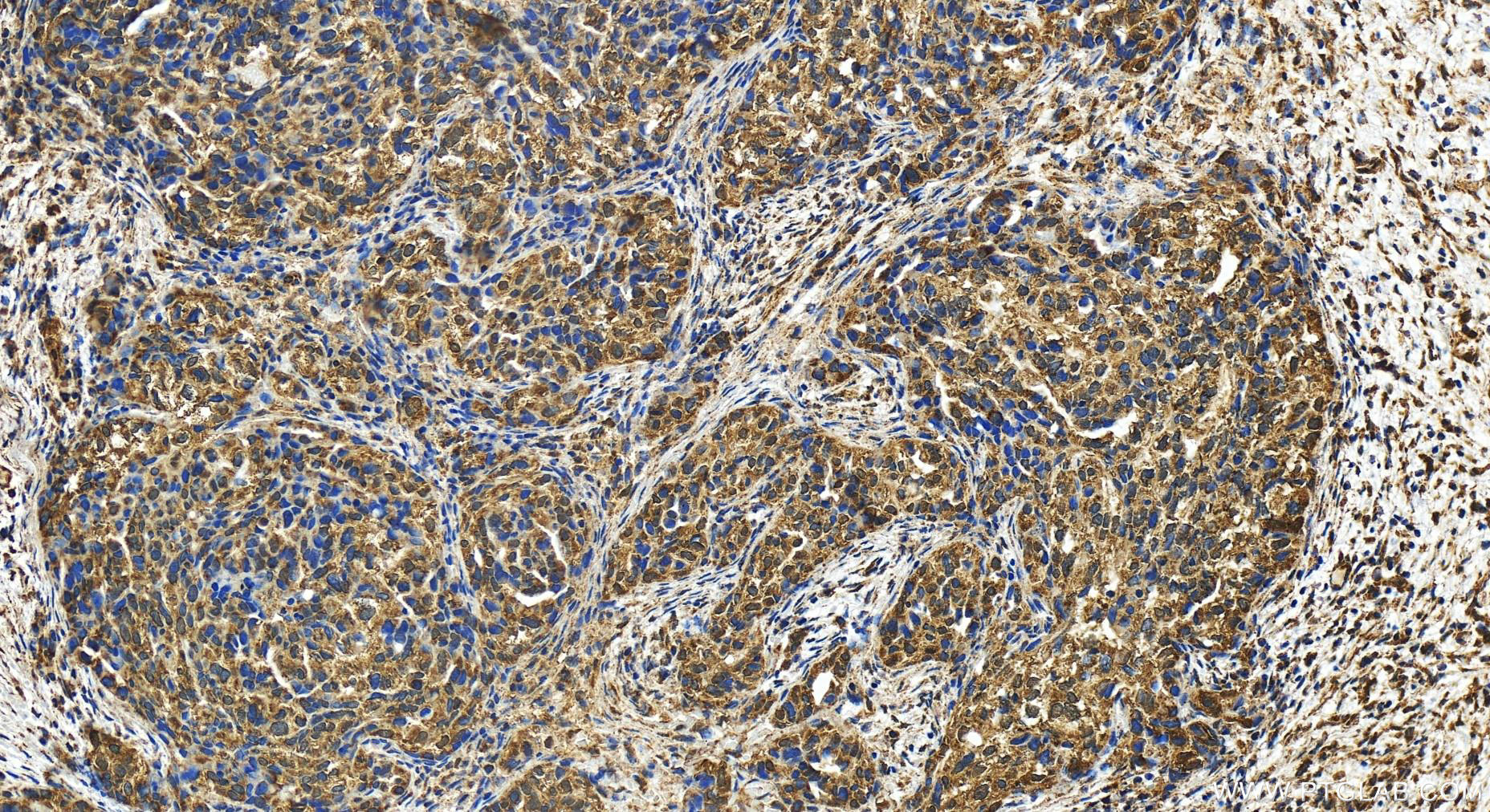 Immunohistochemistry (IHC) staining of human ovary cancer tissue using PAM16 Polyclonal antibody (15321-1-AP)