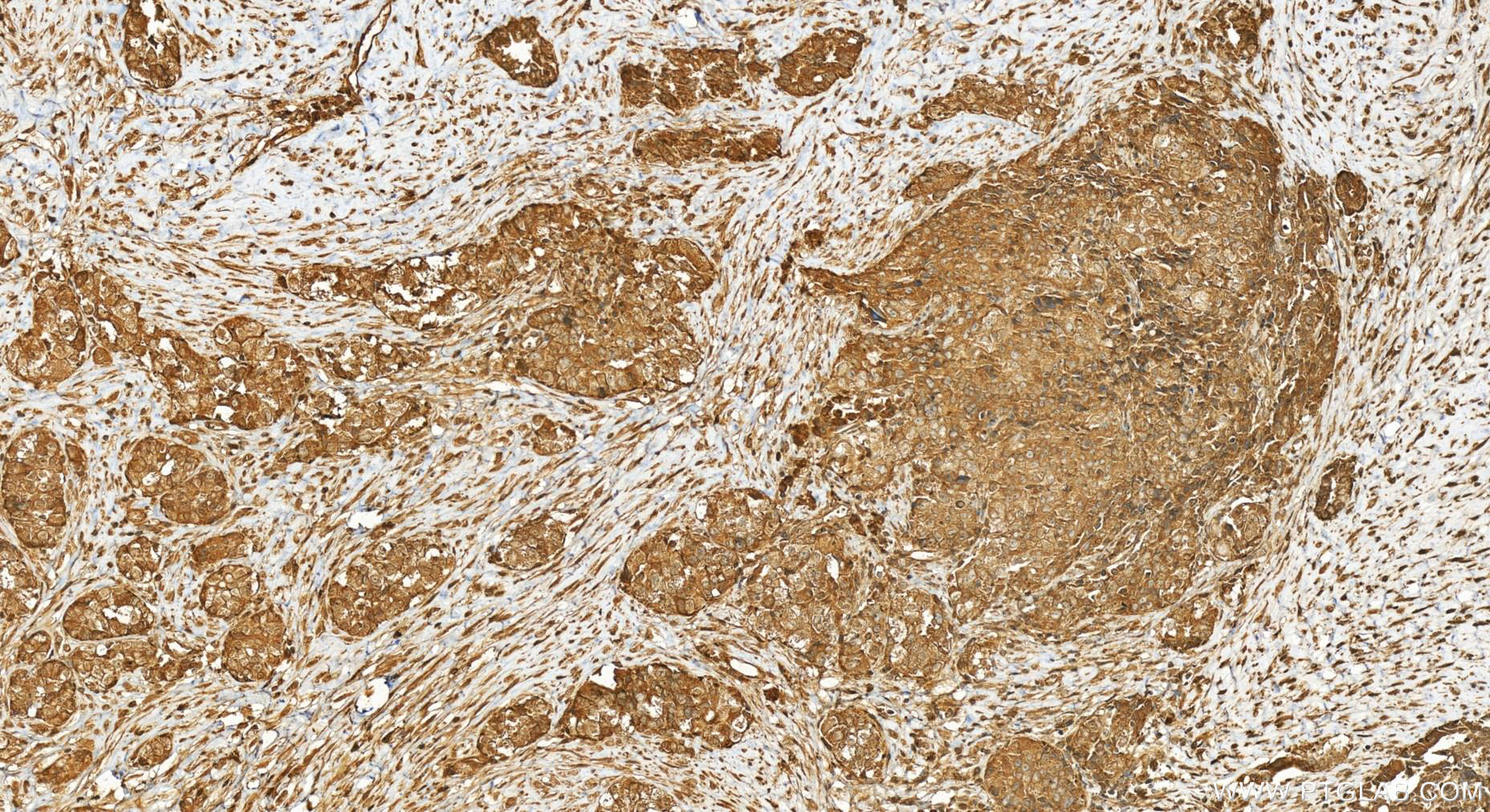 Immunohistochemistry (IHC) staining of human ovary cancer tissue using PAN3 Polyclonal antibody (25655-1-AP)