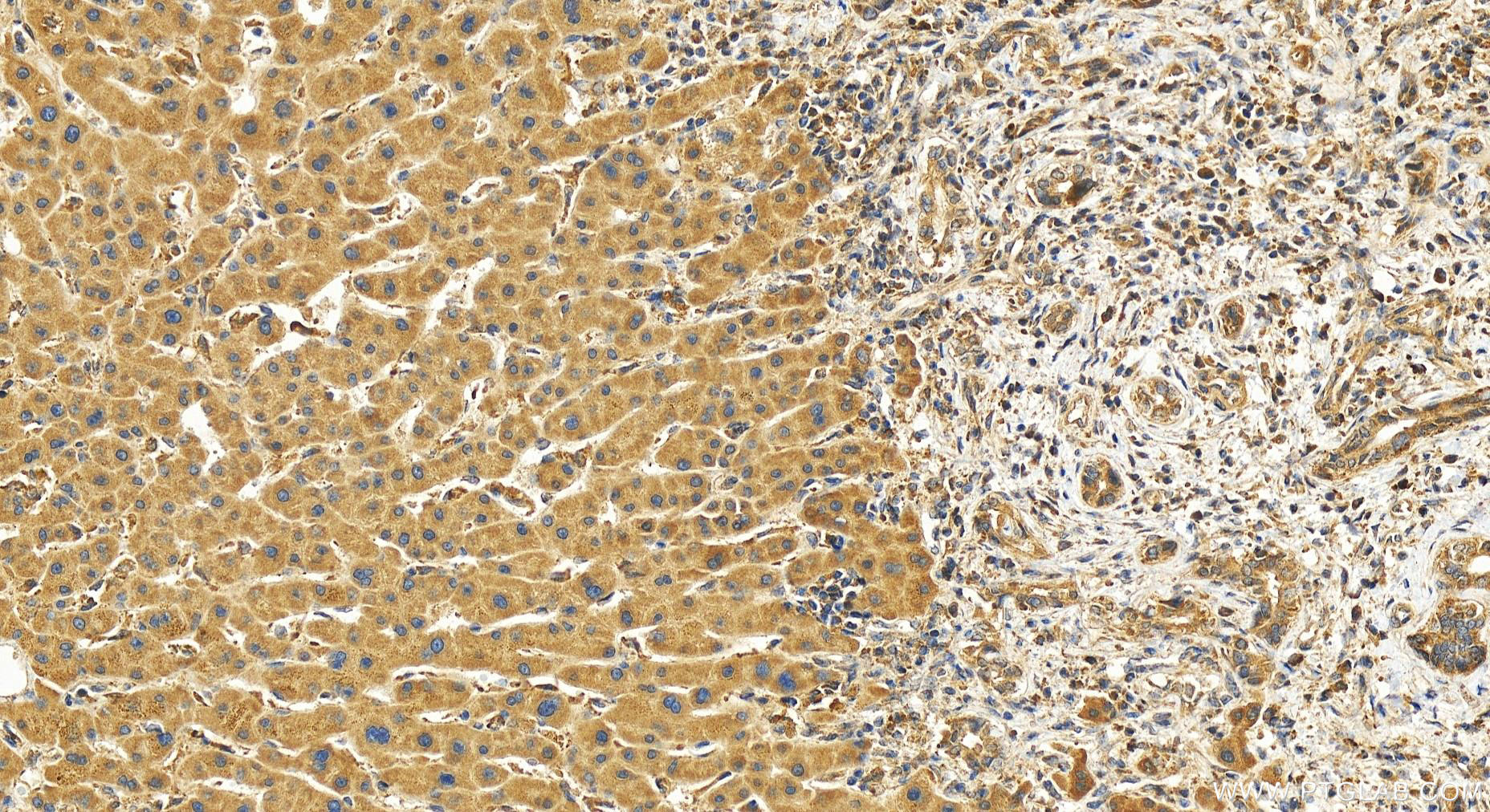 Immunohistochemistry (IHC) staining of human intrahepatic cholangiocarcinoma tissue using PARP10 Polyclonal antibody (26072-1-AP)