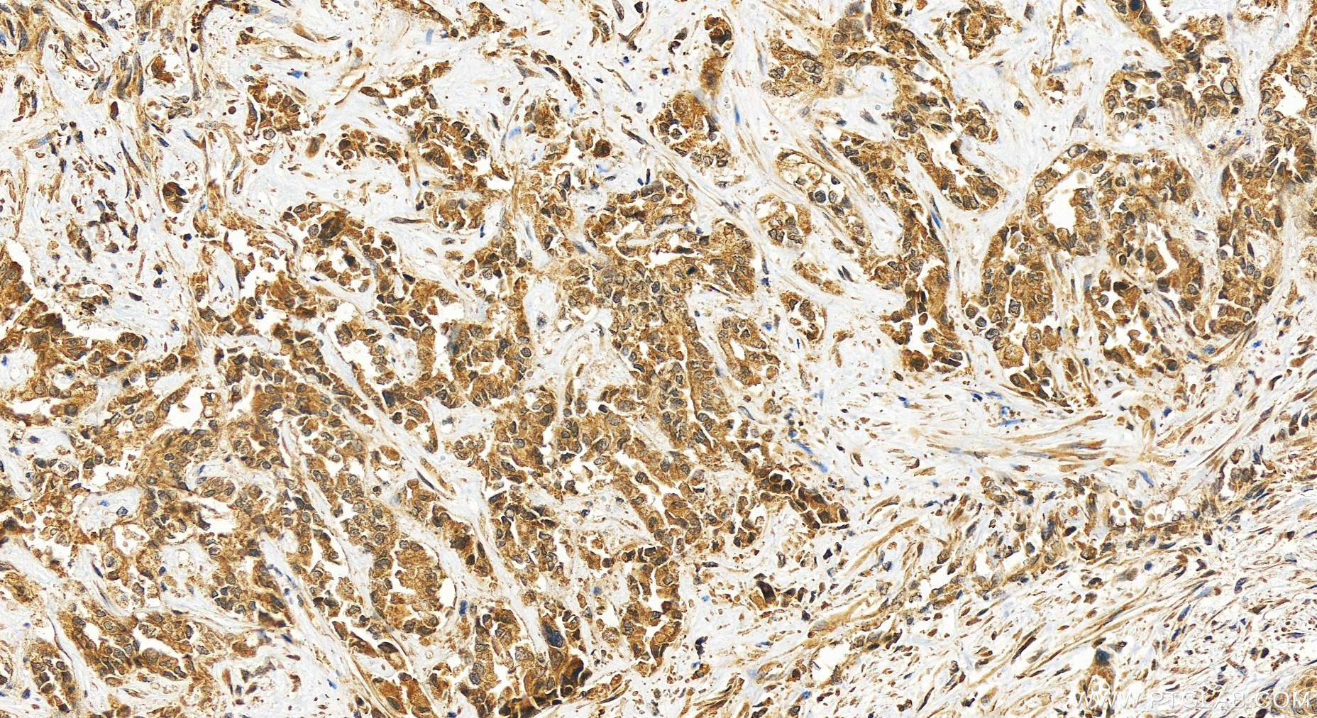 Immunohistochemistry (IHC) staining of human intrahepatic cholangiocarcinoma tissue using PARP10 Polyclonal antibody (26072-1-AP)