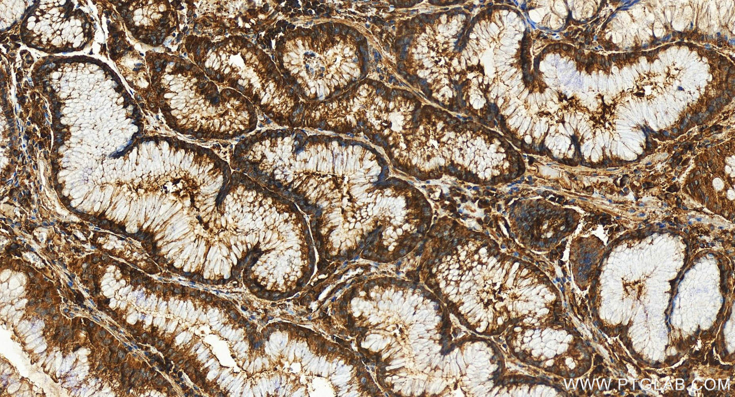 Immunohistochemistry (IHC) staining of human stomach cancer tissue using Alpha Parvin/Actopaxin Polyclonal antibody (55268-1-AP)