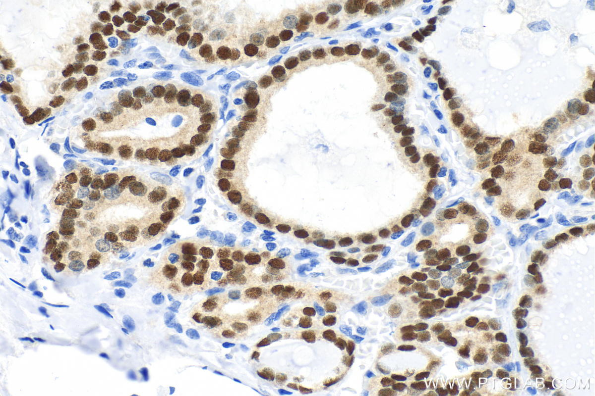 Immunohistochemistry (IHC) staining of human thyroid cancer tissue using PAX8 Polyclonal antibody (10336-1-AP)
