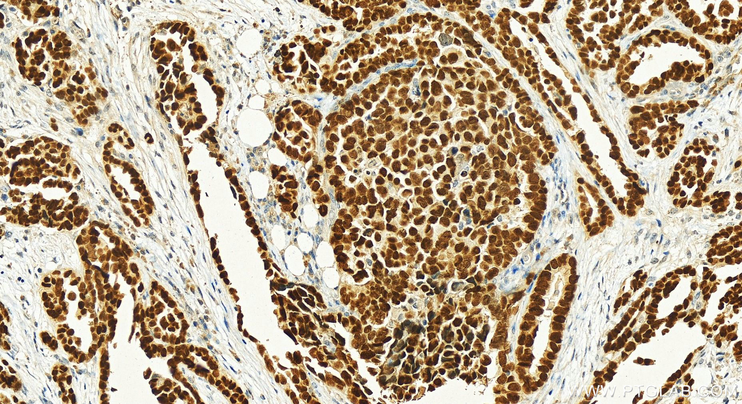 Immunohistochemistry (IHC) staining of human ovary cancer tissue using PAX8 Polyclonal antibody (10336-1-AP)