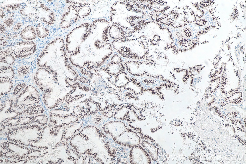 Immunohistochemistry (IHC) staining of human ovary tumor tissue using PAX8 Monoclonal antibody (60145-4-Ig)