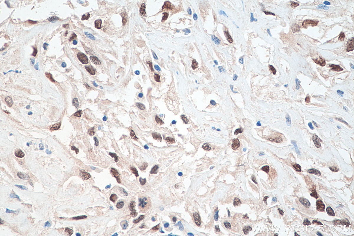 Immunohistochemistry (IHC) staining of human renal cell carcinoma tissue using PAX8 Monoclonal antibody (60145-4-Ig)