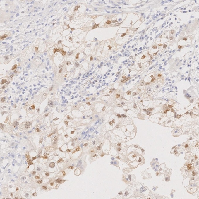 Immunohistochemistry (IHC) staining of human ovary cancer tissue using PAX8 Monoclonal antibody (60145-4-Ig)