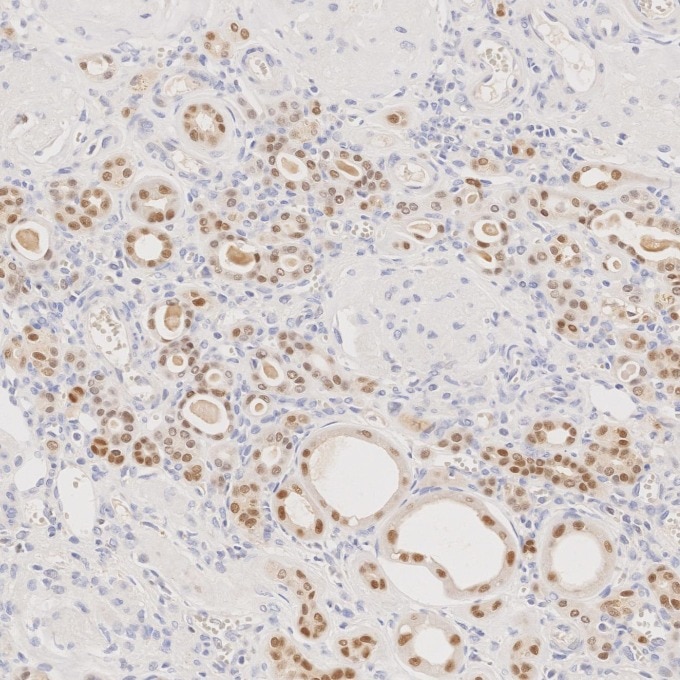 Immunohistochemistry (IHC) staining of human renal cell carcinoma tissue using PAX8 Monoclonal antibody (60145-4-Ig)