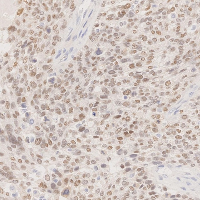 Immunohistochemistry (IHC) staining of human ovary cancer tissue using PAX8 Monoclonal antibody (60145-4-Ig)