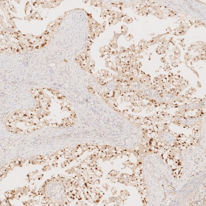 Immunohistochemistry (IHC) staining of human ovary cancer tissue using PAX8 Monoclonal antibody (60145-4-Ig)