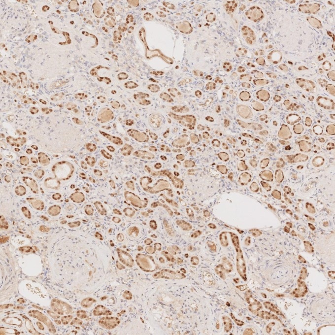 Immunohistochemistry (IHC) staining of human renal cell carcinoma tissue using PAX8 Monoclonal antibody (60145-4-Ig)