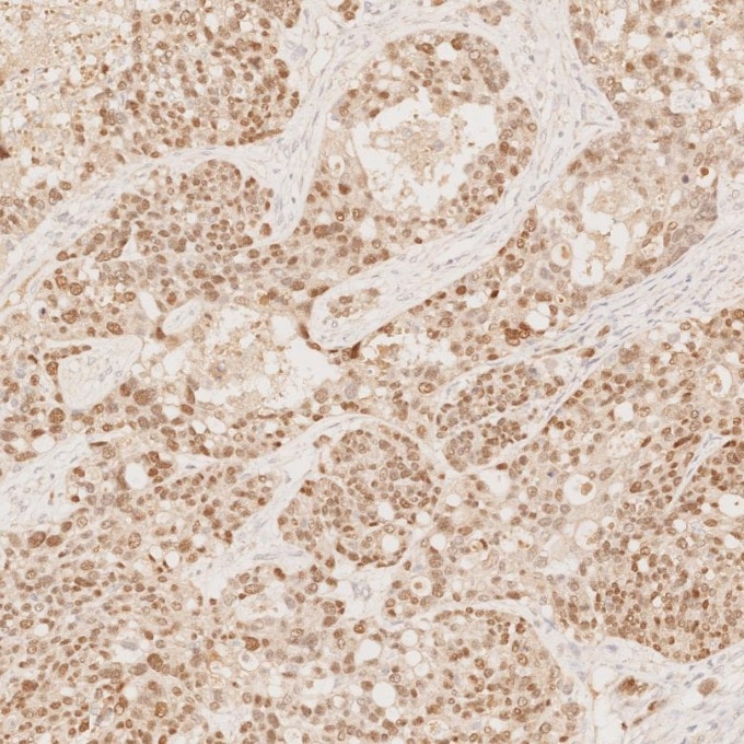 Immunohistochemistry (IHC) staining of human ovary cancer tissue using PAX8 Monoclonal antibody (60145-4-Ig)