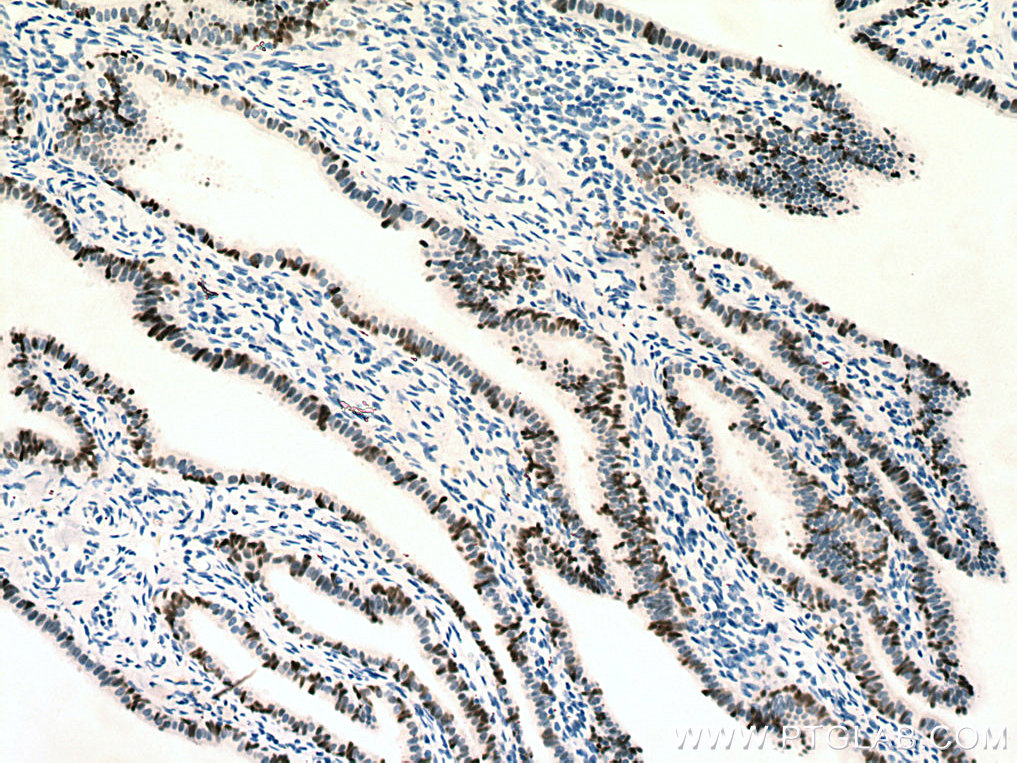 Immunohistochemistry (IHC) staining of human ovary tumor tissue using PAX8 Recombinant antibody (80022-1-RR)