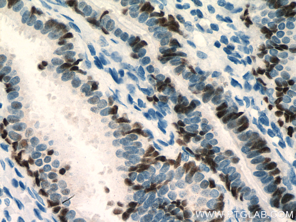 Immunohistochemistry (IHC) staining of human ovary tumor tissue using PAX8 Recombinant antibody (80022-1-RR)