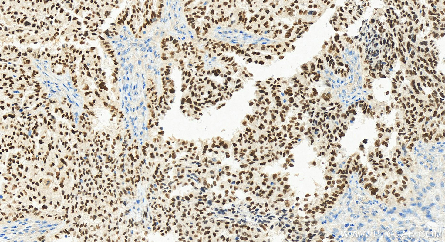 Immunohistochemistry (IHC) staining of human ovary cancer tissue using PAX8 Recombinant antibody (80756-1-RR)