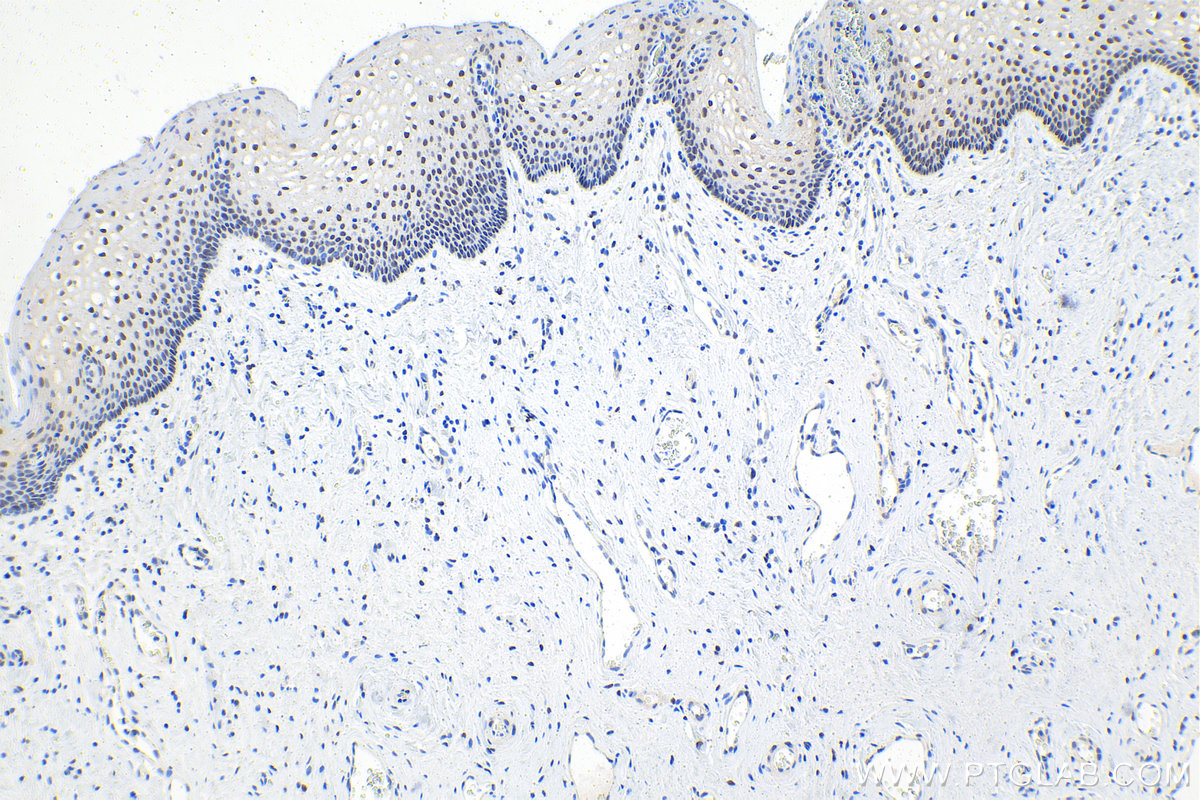 Immunohistochemistry (IHC) staining of human cervical cancer tissue using PBX1 Polyclonal antibody (18204-1-AP)