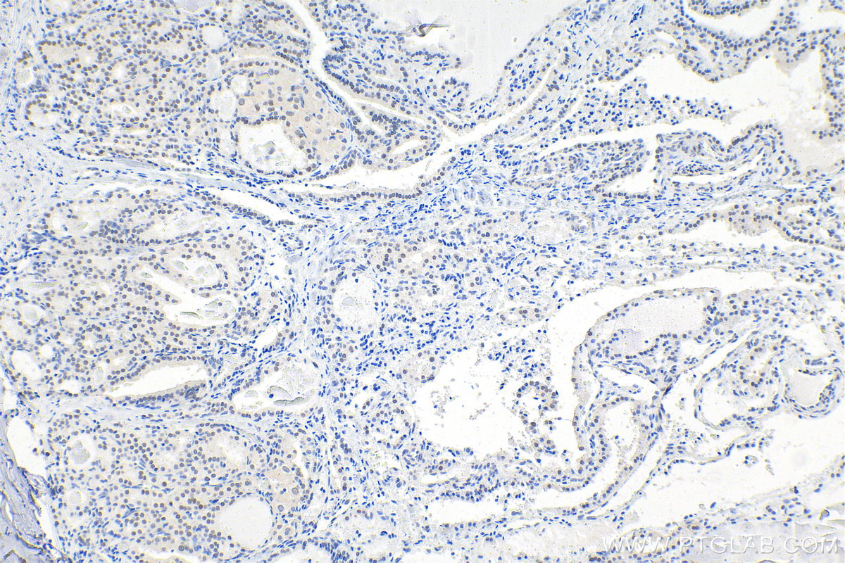 Immunohistochemistry (IHC) staining of human thyroid cancer tissue using PBX1 Polyclonal antibody (18204-1-AP)