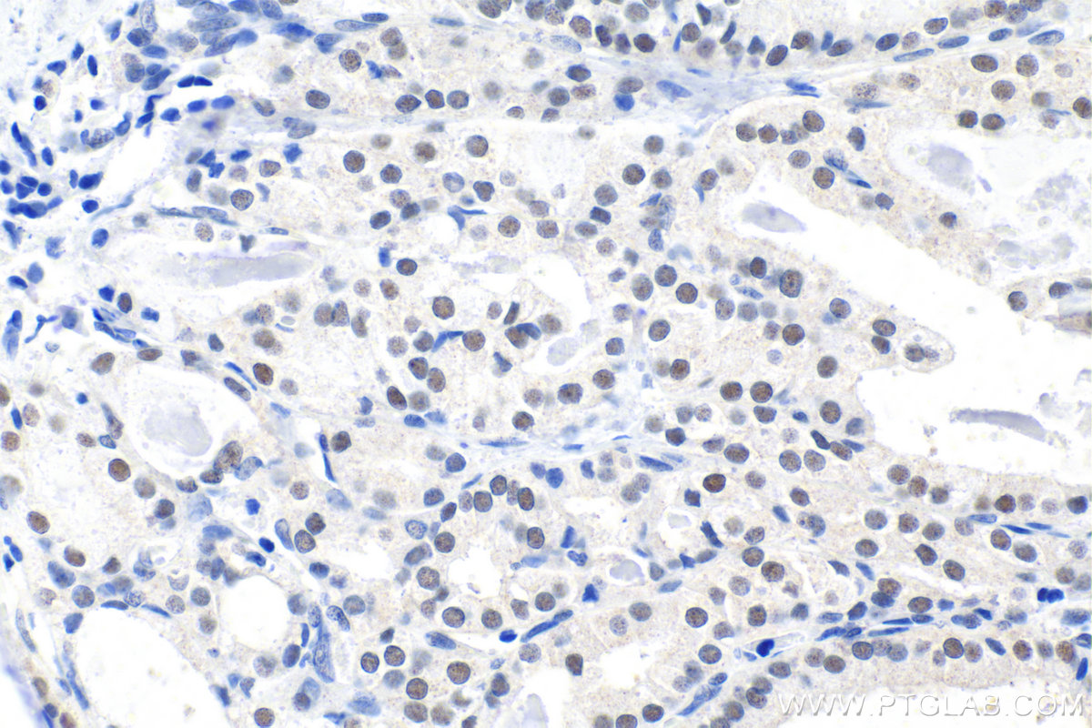 Immunohistochemistry (IHC) staining of human thyroid cancer tissue using PBX1 Polyclonal antibody (18204-1-AP)