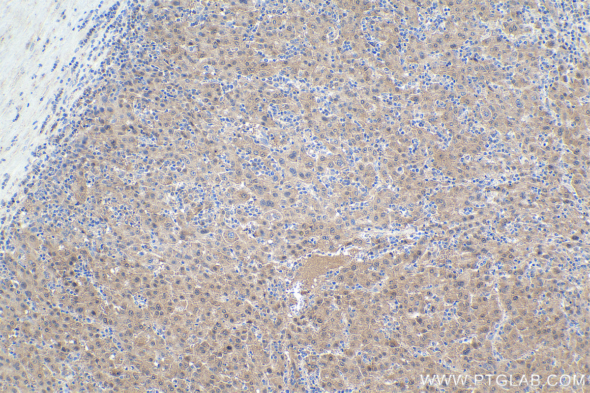 Immunohistochemistry (IHC) staining of human liver cancer tissue using PCBD1 Polyclonal antibody (15702-1-AP)