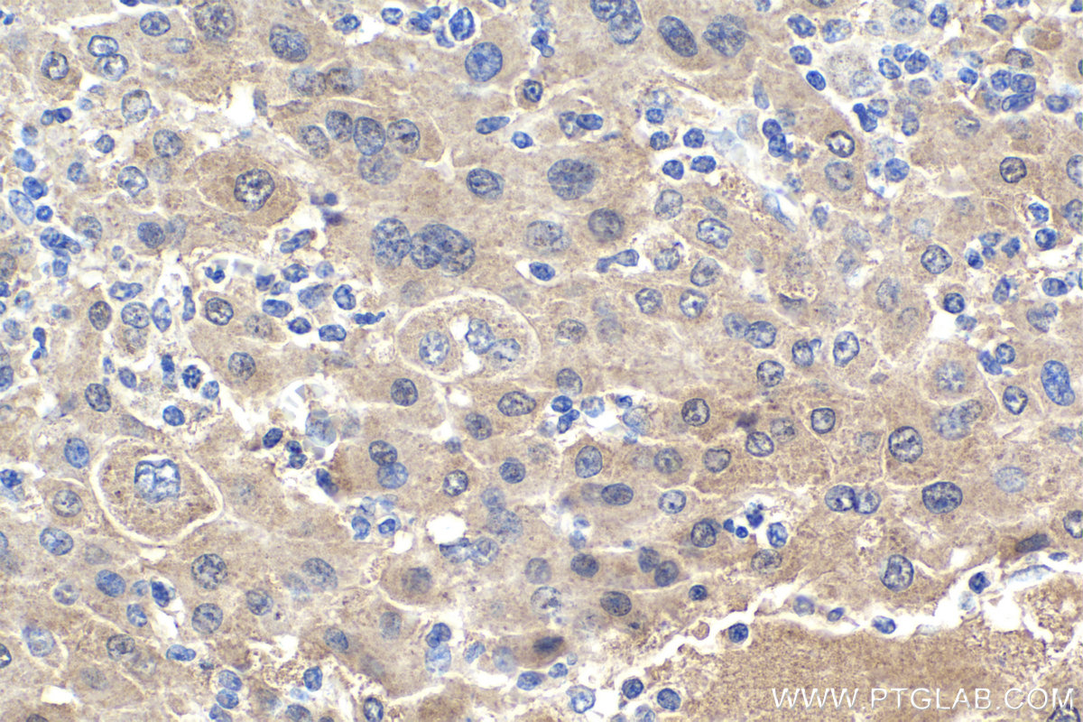 Immunohistochemistry (IHC) staining of human liver cancer tissue using PCBD1 Polyclonal antibody (15702-1-AP)