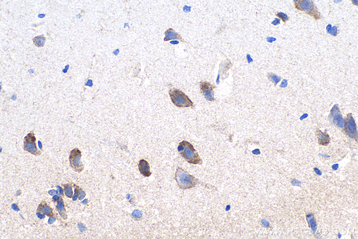 Immunohistochemistry (IHC) staining of human gliomas tissue using PCDH11X Polyclonal antibody (20070-1-AP)