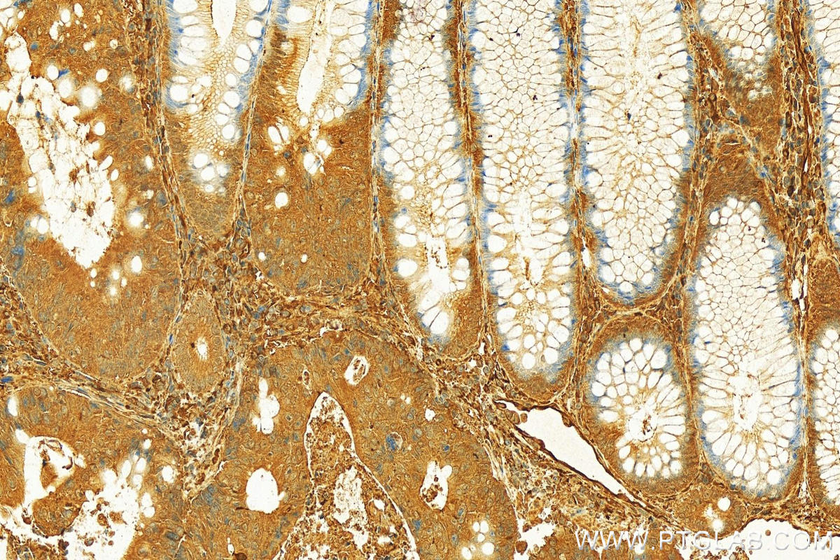 Immunohistochemistry (IHC) staining of human colon cancer tissue using PCDH24 Polyclonal antibody (27103-1-AP)