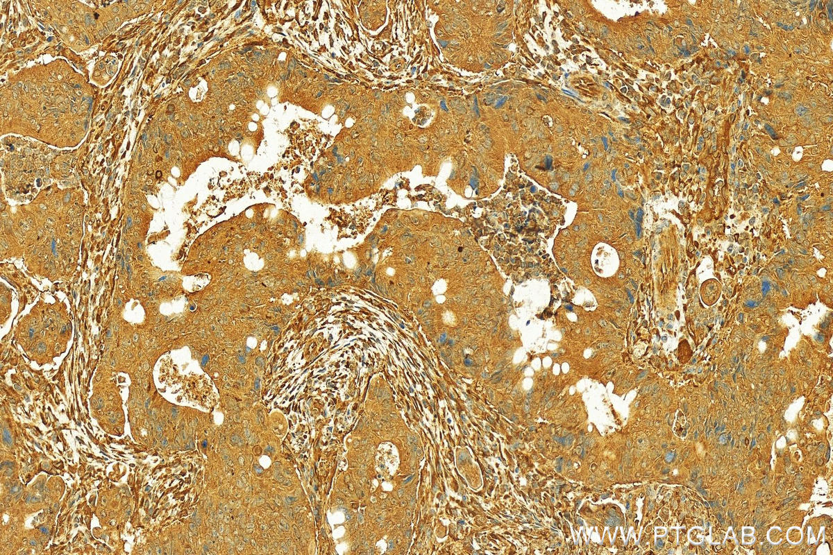 Immunohistochemistry (IHC) staining of human colon cancer tissue using PCDH24 Polyclonal antibody (27103-1-AP)