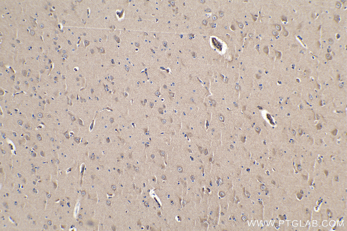 Immunohistochemistry (IHC) staining of human gliomas tissue using PCDHB10 Polyclonal antibody (14785-1-AP)