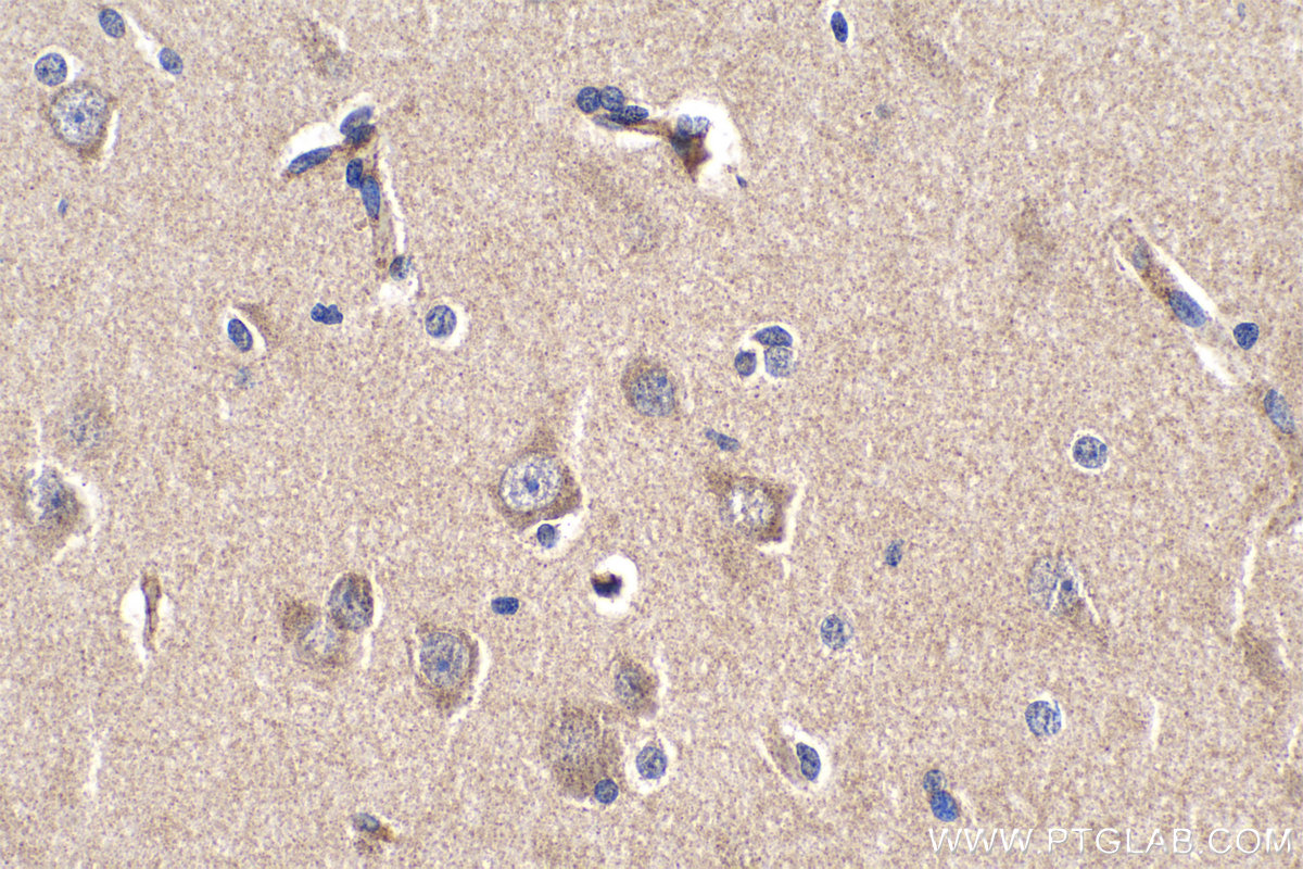 Immunohistochemistry (IHC) staining of human gliomas tissue using PCDHB10 Polyclonal antibody (14785-1-AP)