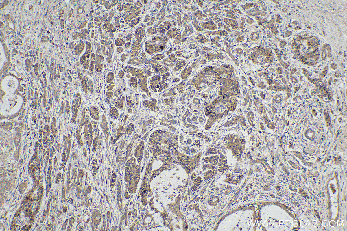 Immunohistochemistry (IHC) staining of human pancreas cancer tissue using PCDHB10 Polyclonal antibody (14785-1-AP)