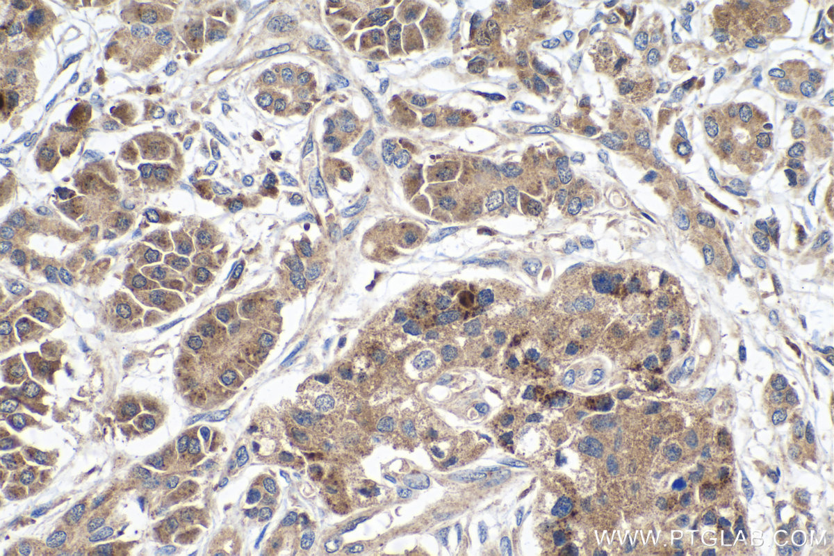 Immunohistochemistry (IHC) staining of human pancreas cancer tissue using PCDHB10 Polyclonal antibody (14785-1-AP)