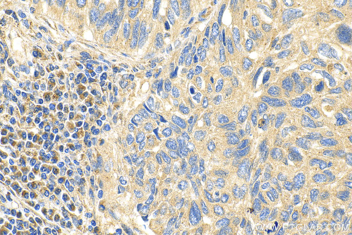 Immunohistochemistry (IHC) staining of human lung cancer tissue using PCDHGC5 Polyclonal antibody (23848-1-AP)