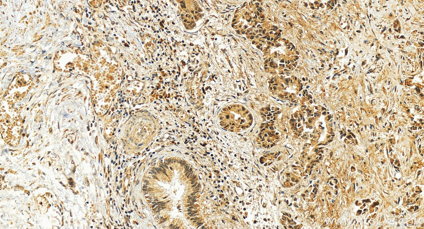 Immunohistochemistry (IHC) staining of human intrahepatic cholangiocarcinoma tissue using PCF11 Polyclonal antibody (23540-1-AP)